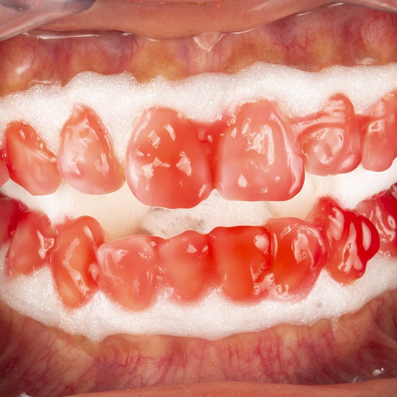 branqueamento dentário