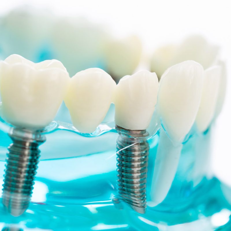 Implante dentário