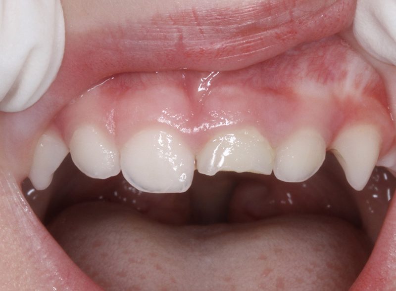 traumatismo no dente