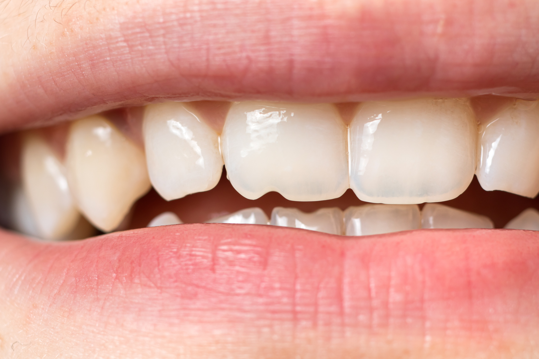 Traumatismo dentário
