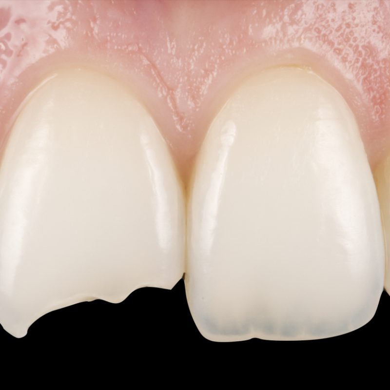 restauração estética antes